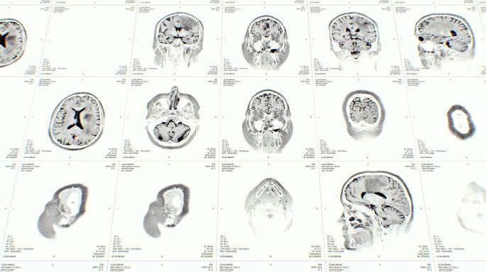 核磁共振医学医疗大脑神经
