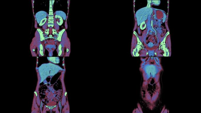 腹腔、胃肠道、膀胱的彩色对比MRI