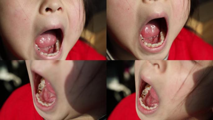 小孩虫牙虫牙坏牙