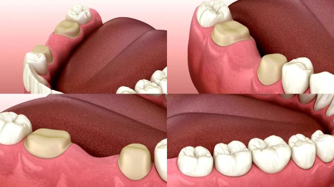 人体牙齿治疗的医学精确3D动画