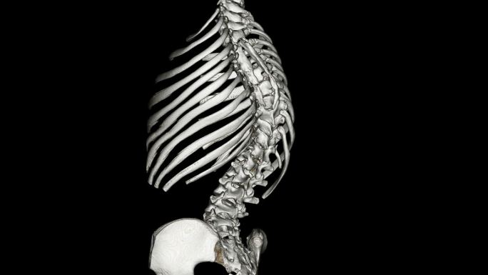 脊柱侧凸三维医学器官3D人体
