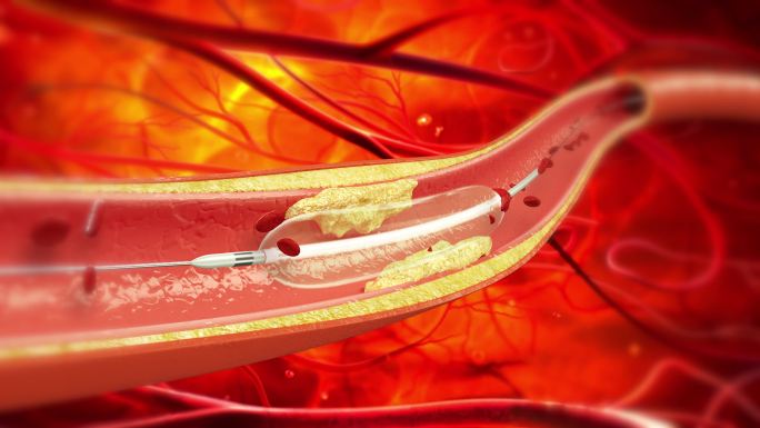 心脏支架演示视频
