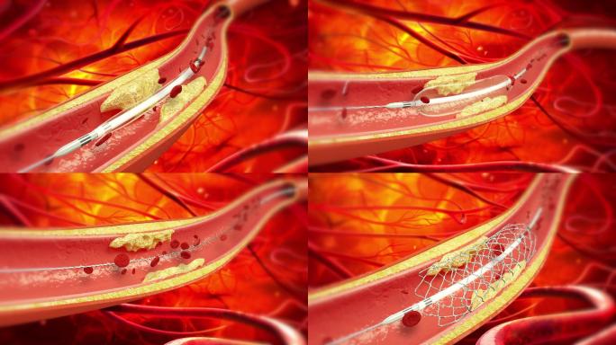 心脏支架演示视频
