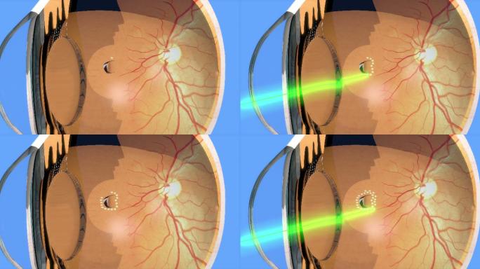 视网膜医学影像眼睛三维效果视力