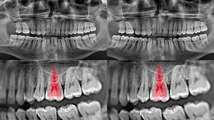 牙科数字全景X光片，红色显示疼痛