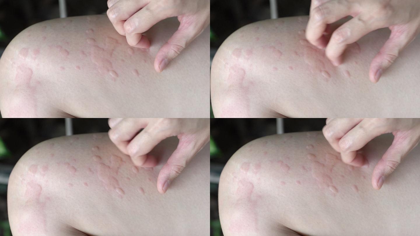 女性手抓荨麻疹或身体过敏