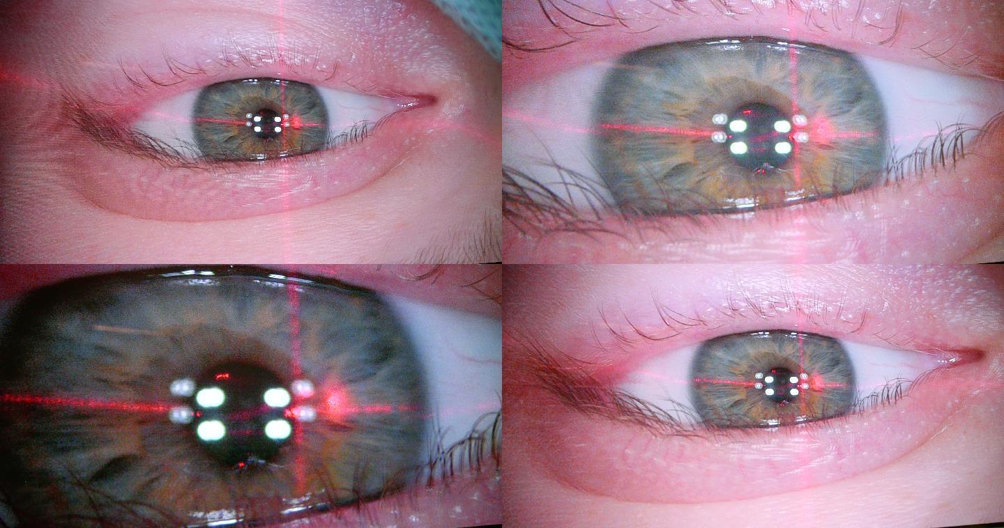 眼科激光视力矫正手术