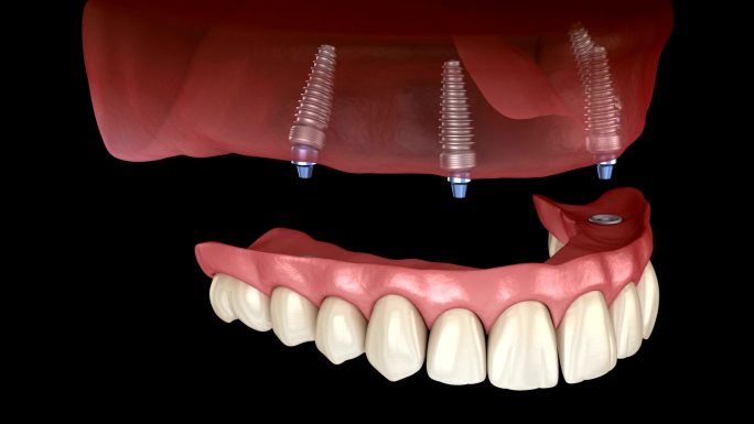 人体牙齿和假牙牙齿美容视频素材牙齿矫正