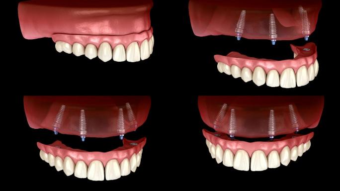 人体牙齿和假牙牙齿美容视频素材牙齿矫正