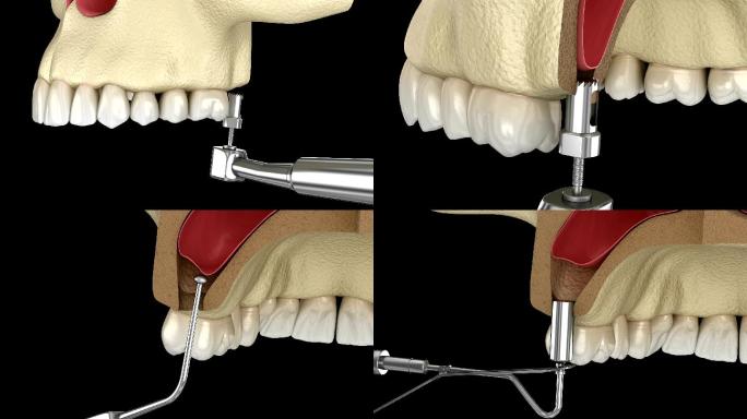 鼻窦提升手术——鼻窦扩大术。3D动画