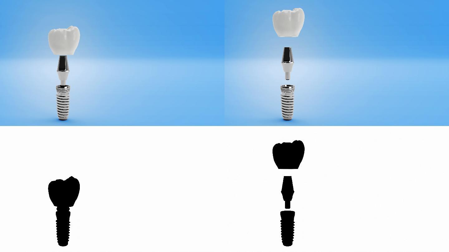 3D牙科植入物