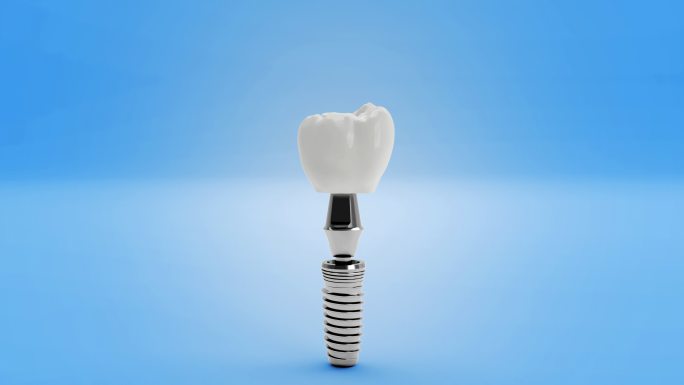 3D牙齿植入物牙根