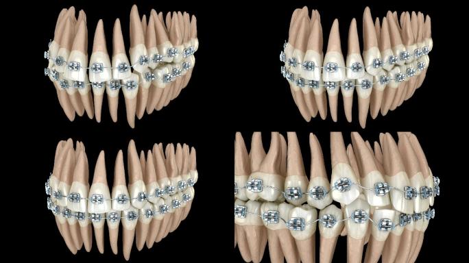 牙齿位置异常，并用金属支架矫正。