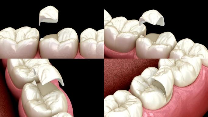 全瓷冠固定在牙齿上。
