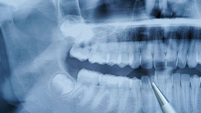 牙医检查牙齿的全景x光片