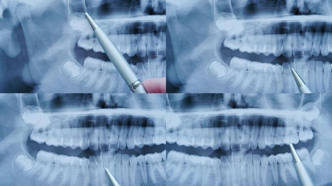 牙医检查牙齿的全景x光片