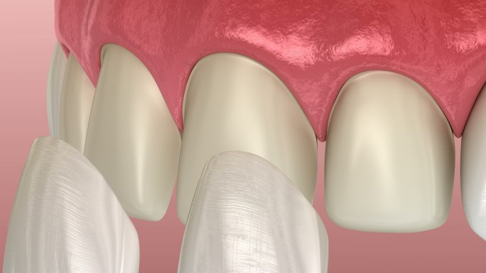 牙齿3D动画口腔保护层镶牙
