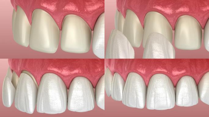 牙齿3D动画口腔保护层镶牙