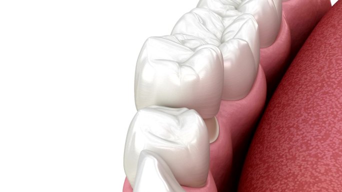 预备前磨牙用于牙科陶瓷冠植入。