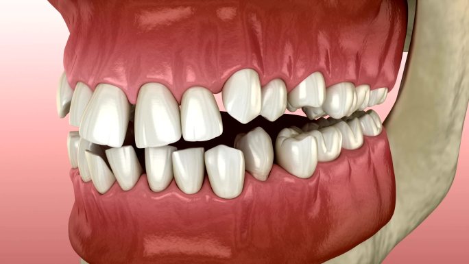 牙齿位置异常，矫正观念。