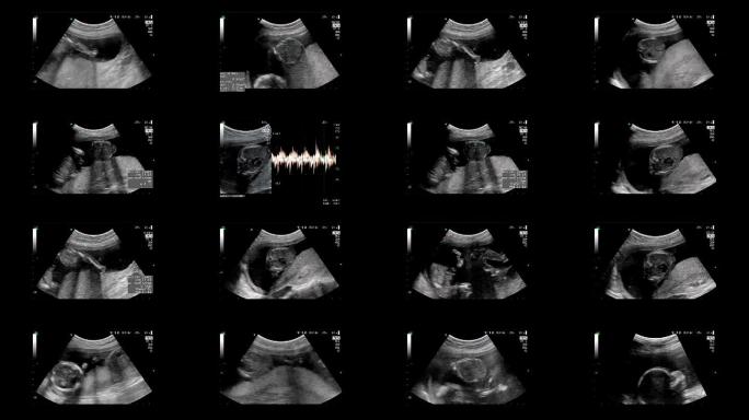 18周时同卵双胞胎心脏跳动的超声检查