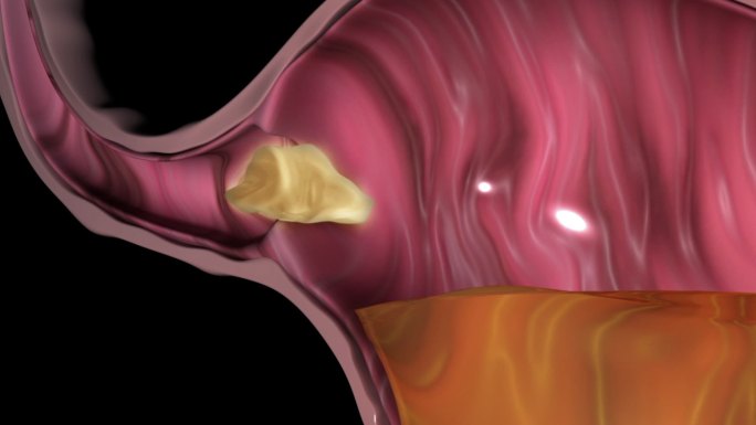 胃食管反流肠胃人体三维动画肠道人体消化系