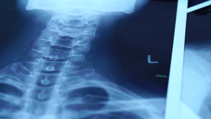 颈椎X线片医疗影像临床诊断依据胶片确证