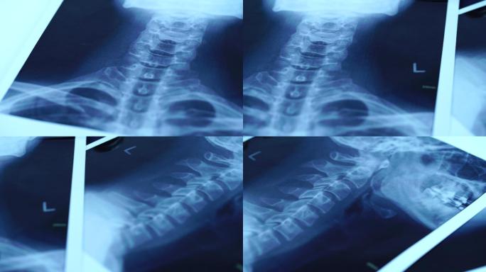 颈椎X线片医疗影像临床诊断依据胶片确证