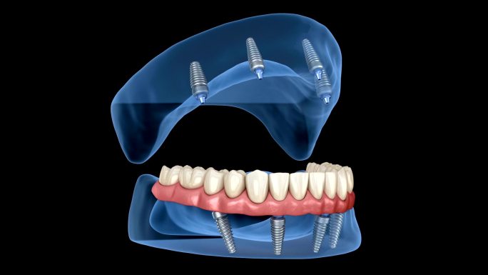 上颌和下颌骨假体修复设备牙齿插图