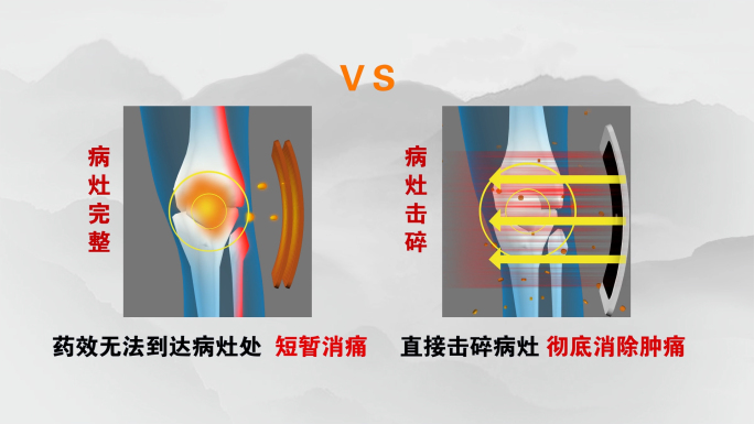 药包和治疗仪的关节炎对比疗效