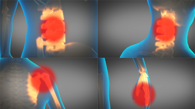 各类骨骼关节劳损症状