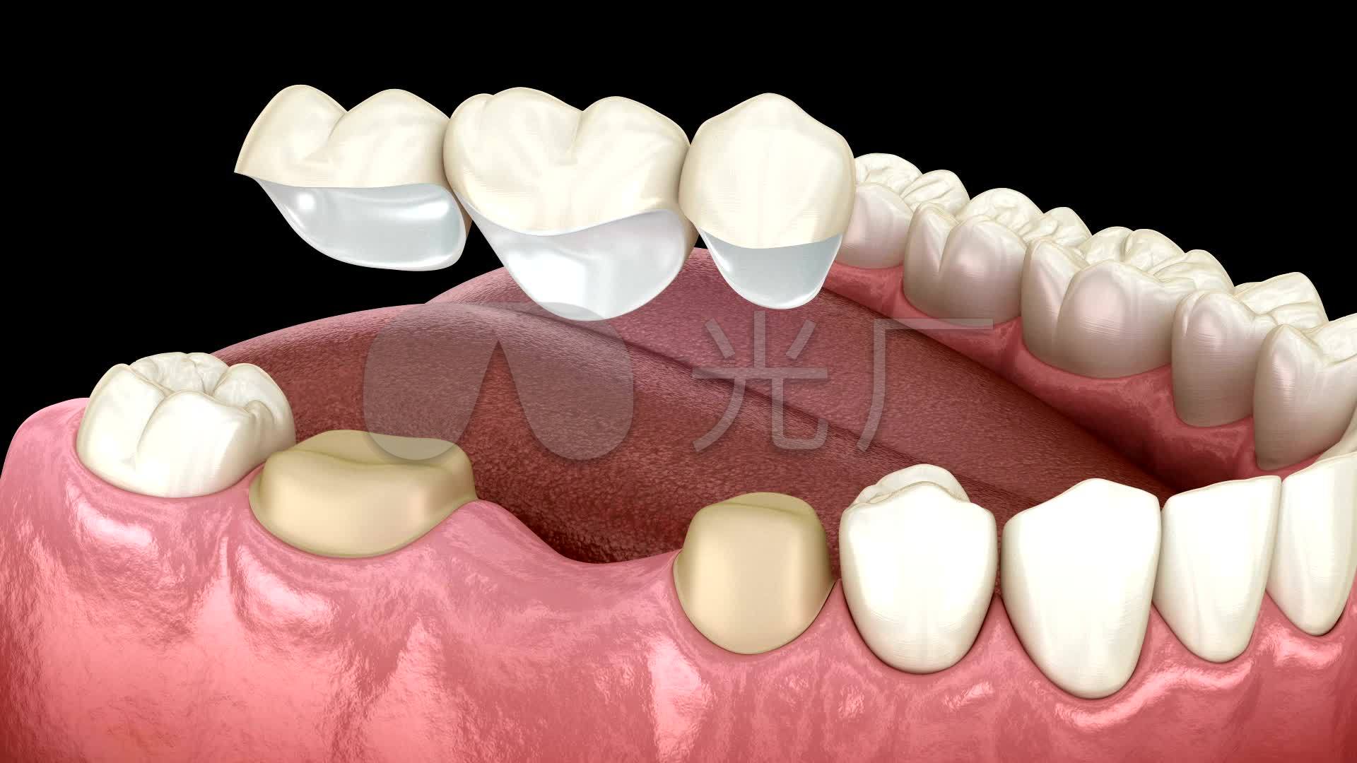 全瓷牙镶牙过程-爱康健齿科