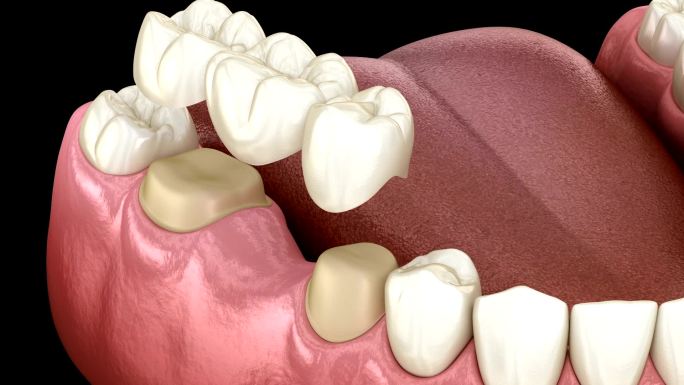牙齿安装3d模型特效素材元素镶牙