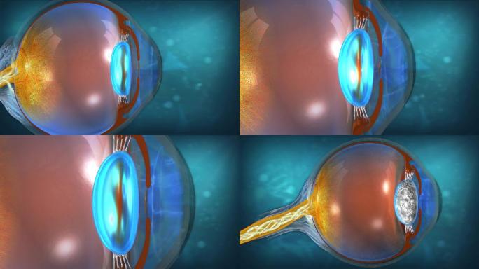 眼球晶状体是没有血管的透明体，非常有弹性
