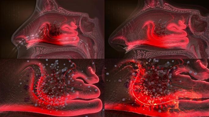 鼻粘膜发炎水肿会阻碍鼻腔通道影响正常呼吸