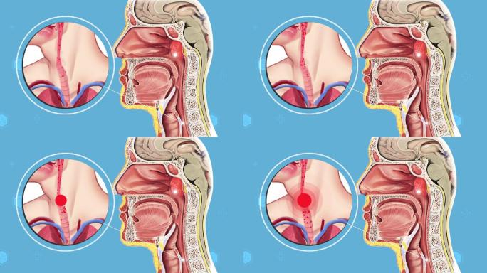 医疗动画 腺样体肥大  咽鼓管咽口堵塞