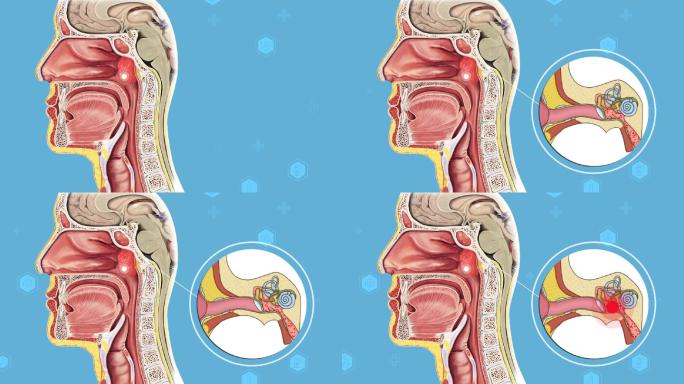 医疗动画 腺样体肥大 咽鼓管咽口堵塞