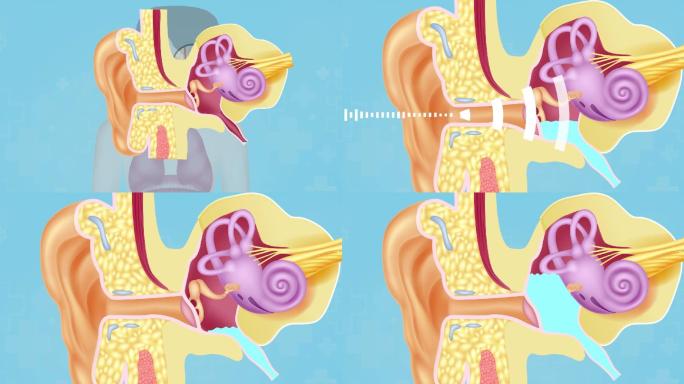 中耳炎耳鸣耳聋听力下降 耳蜗炎症鼓室积液