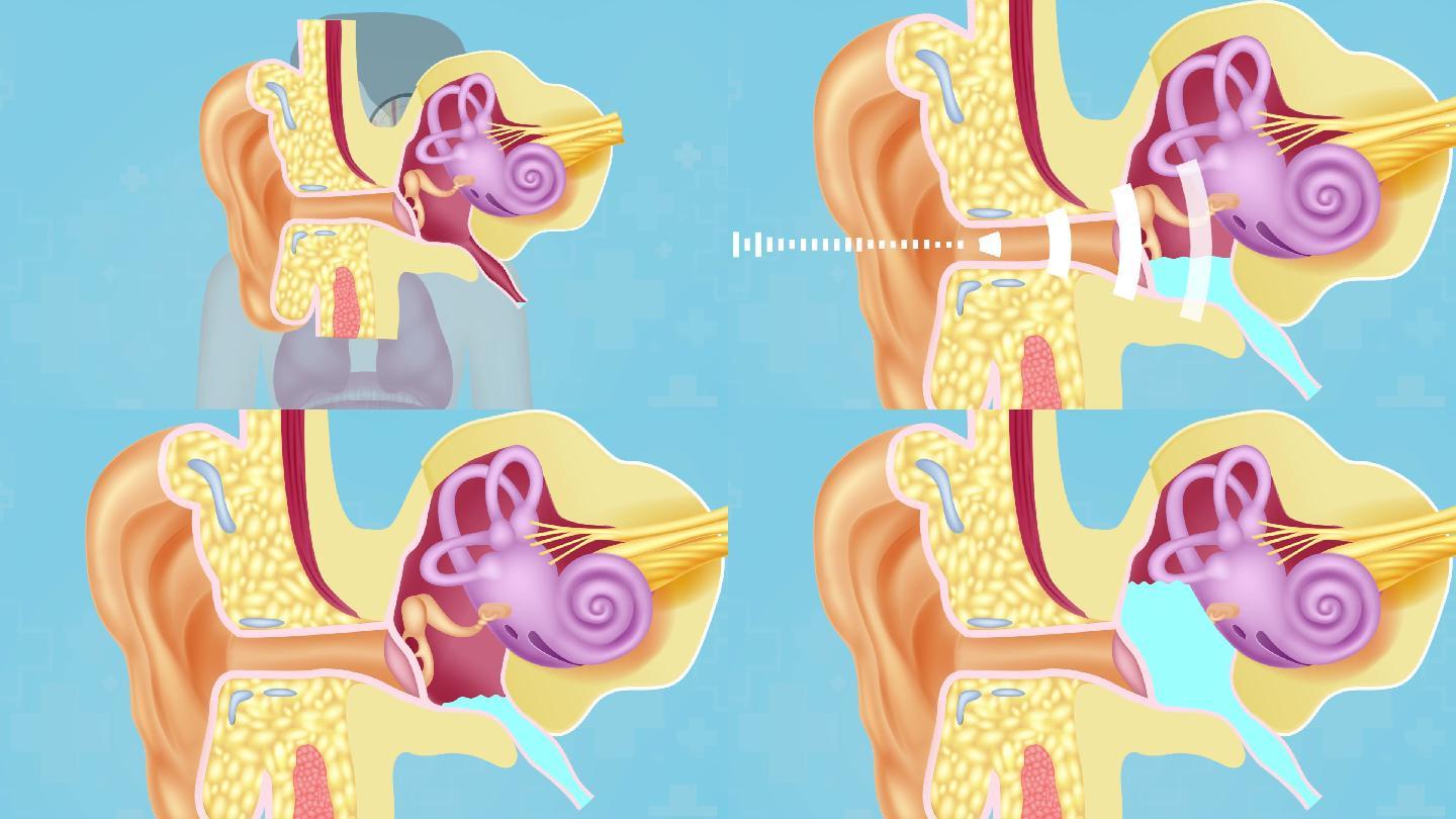 中耳炎耳鸣耳聋听力下降 耳蜗炎症鼓室积液