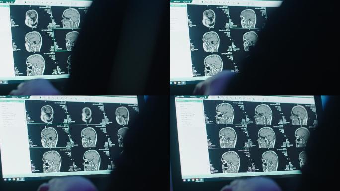 笔记本电脑显示左侧的多个MRI头部扫描