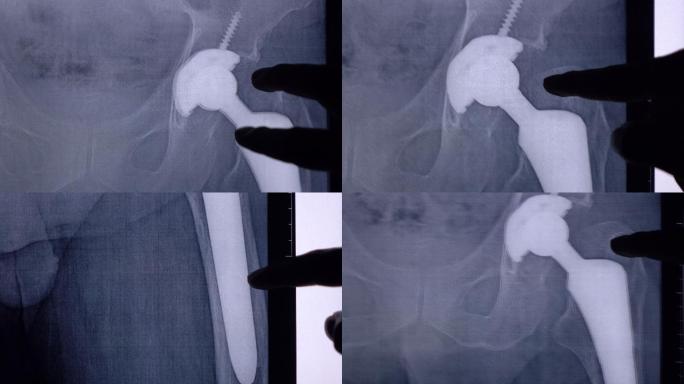 医生在数字平板电脑上检查股骨X射线。