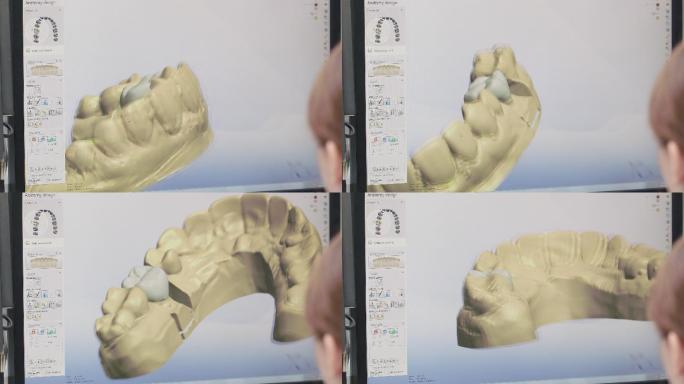 牙科技术人员在3D建模软件中设计牙种植体