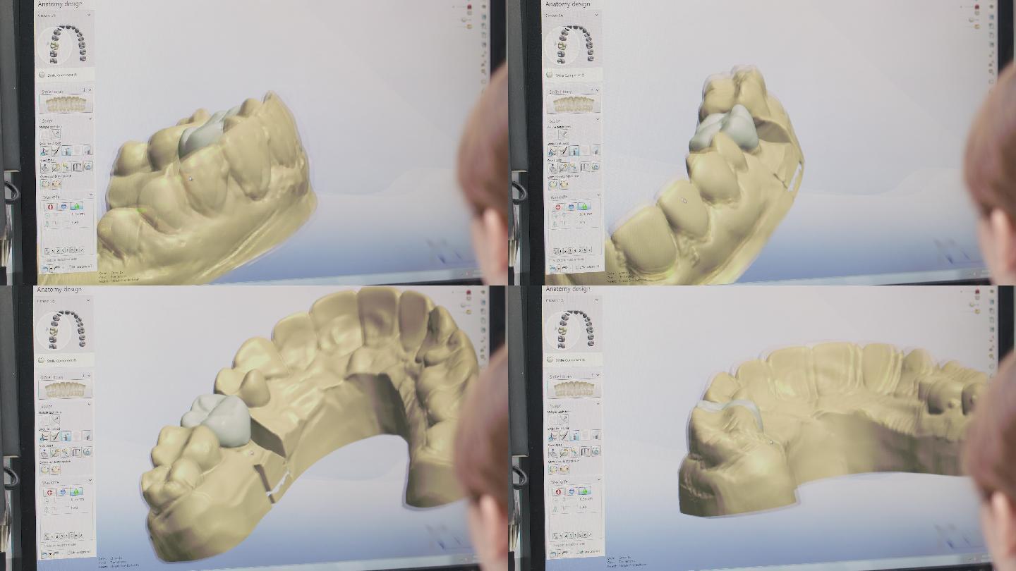 牙科技术人员在3D建模软件中设计牙种植体
