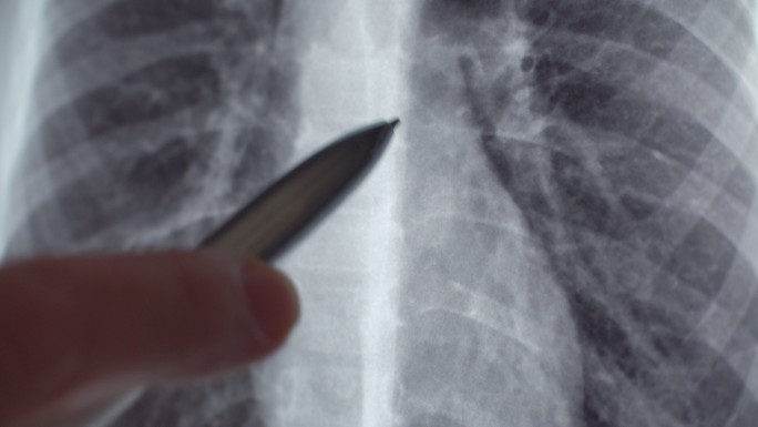 肺部X光片