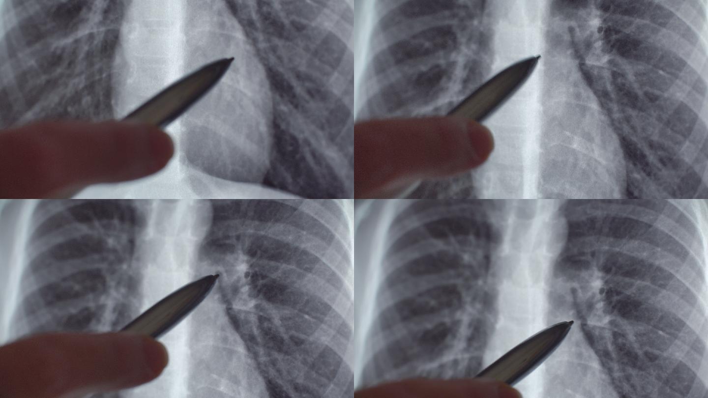 肺部X光片