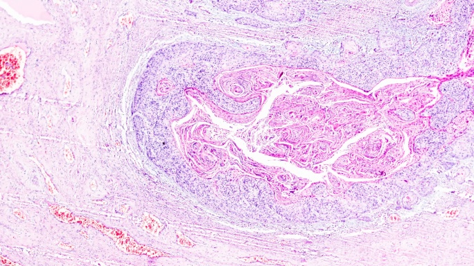 在光学显微镜下，宫颈癌区域