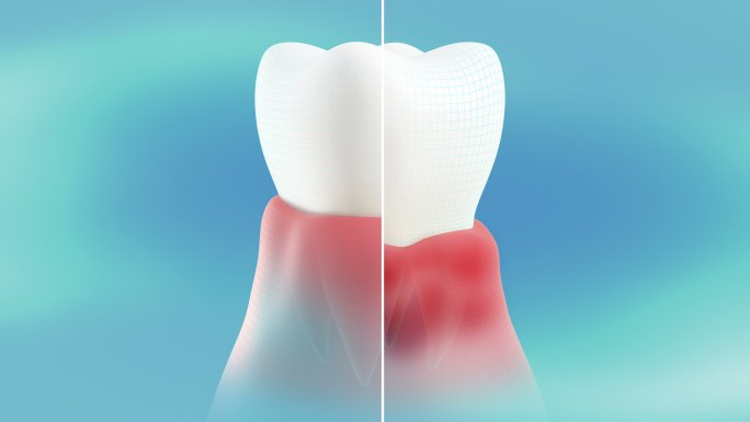 牙龈上的牙周炎。三维3D演示动画发炎感染