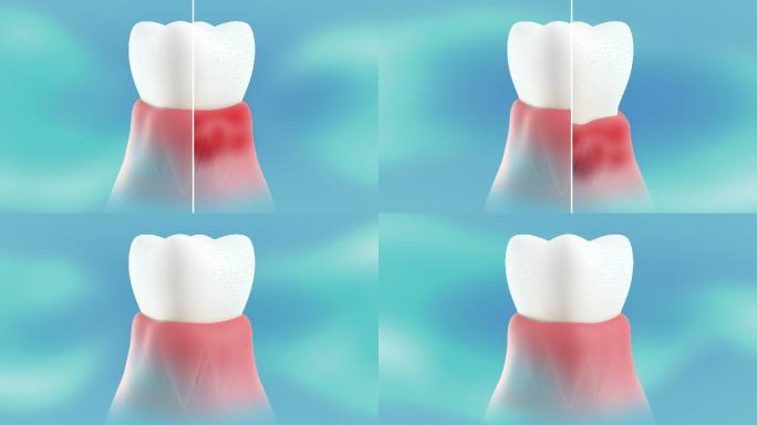 牙龈上的牙周炎。三维3D演示动画发炎感染