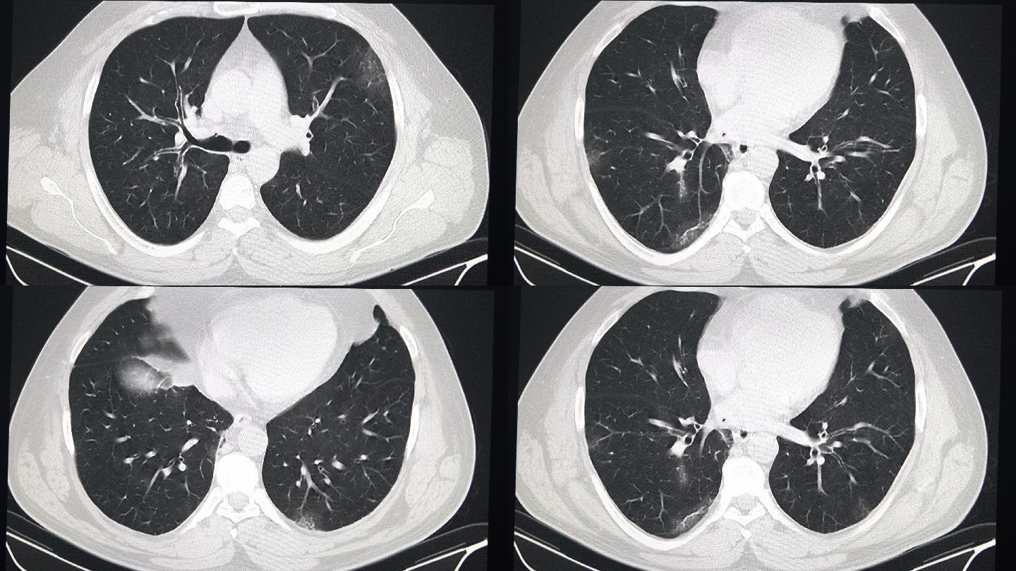 计算机显示器上胸部CT图像