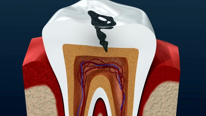 根管感染过程。3D动画。
